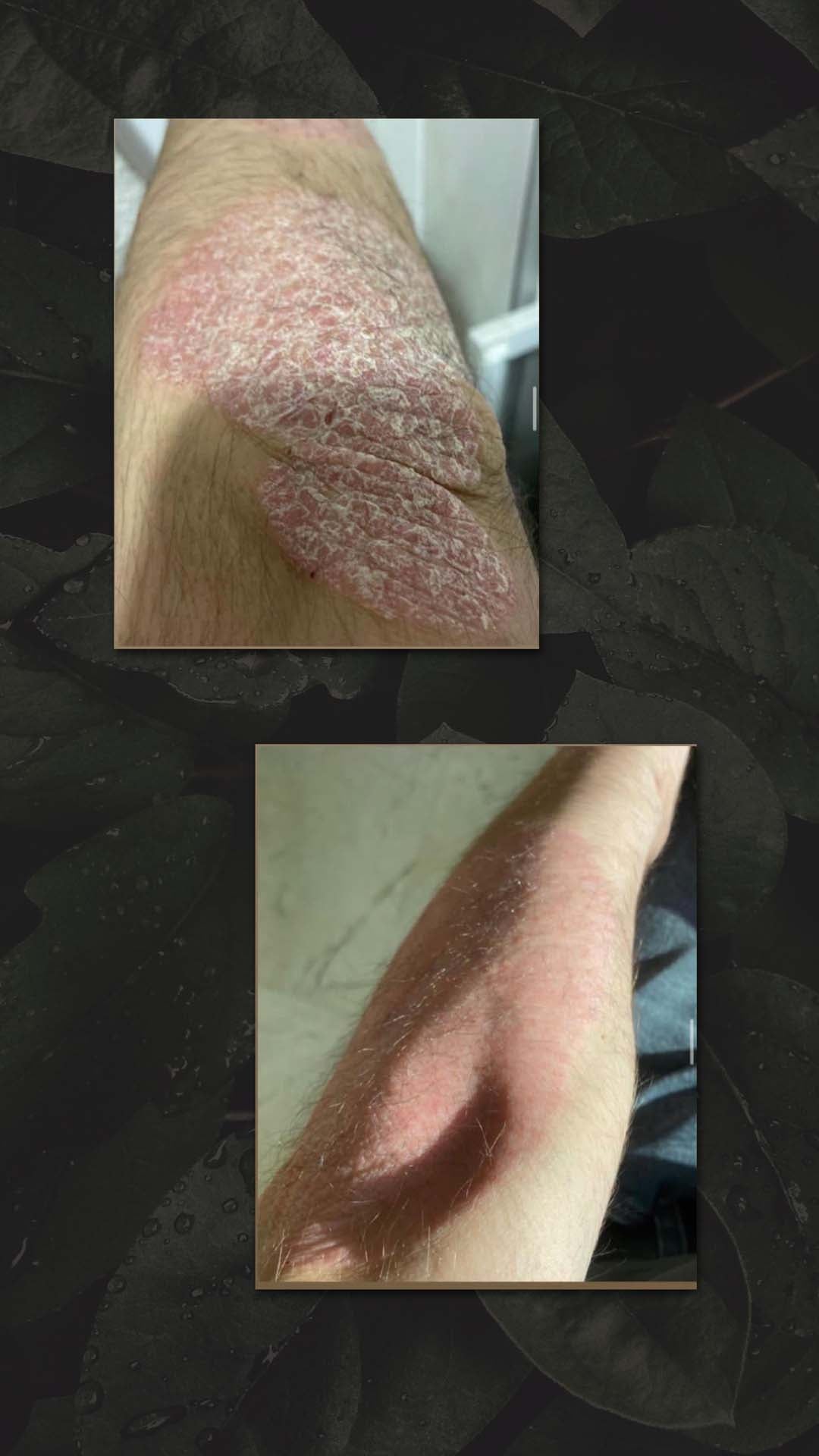 Psoriasis en Eczeem op ellenboog
