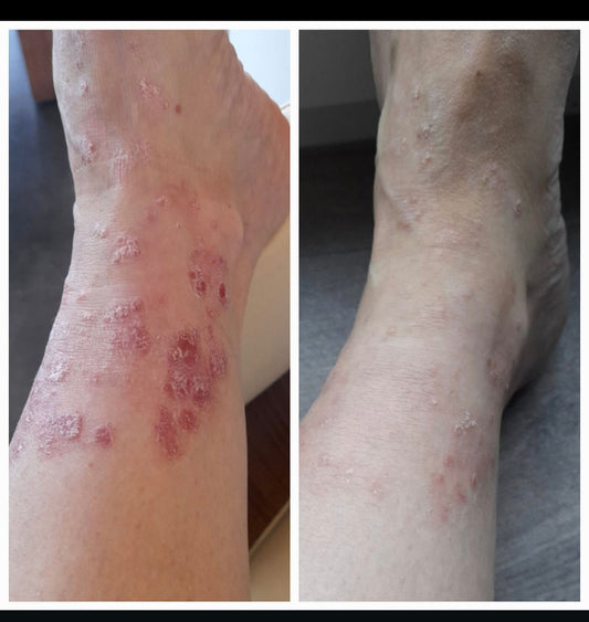 psoriasis enkel before after huid verbetering roodheid schilfers verminderd
