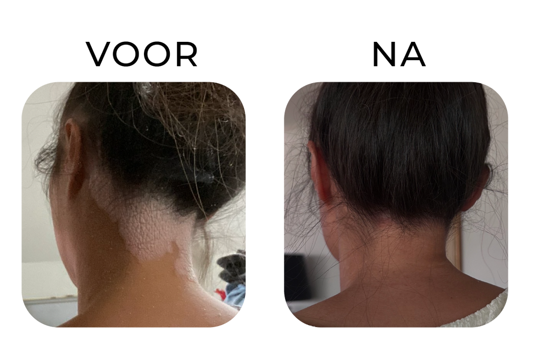 Before en after van eczeem in de nek bij een kind – links een rode, droge en geïrriteerde huid, rechts een zichtbaar rustigere en egalere huid na verzorging.