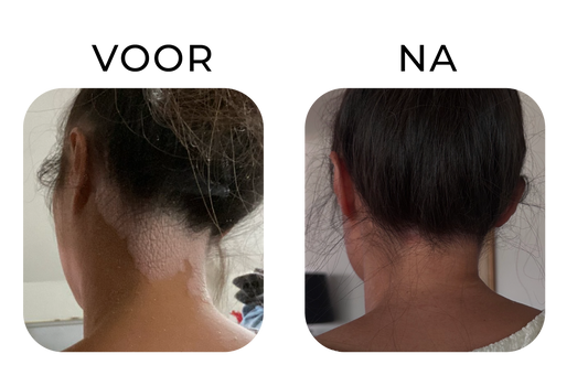Before en after van eczeem in de nek bij een kind – links een rode, droge en geïrriteerde huid, rechts een zichtbaar rustigere en egalere huid na verzorging.