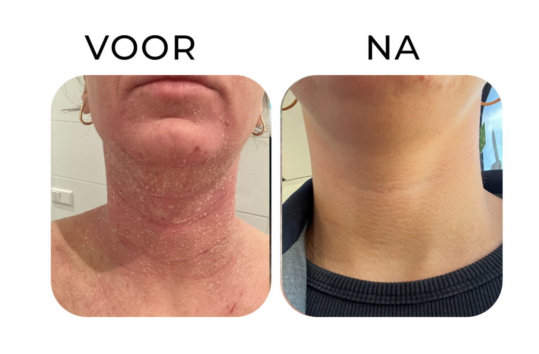 Before en after van ernstig eczeem in de hals – links een rode, droge en schilferige huid, rechts een zichtbaar rustigere, gladdere en beter gehydrateerde huid na verzorging.