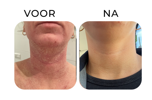 Before en after van ernstig eczeem in de hals – links een rode, droge en schilferige huid, rechts een zichtbaar rustigere, gladdere en beter gehydrateerde huid na verzorging.