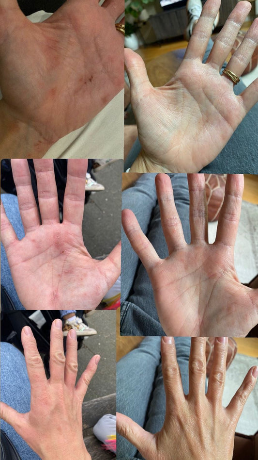 Binnen 3 dagen vrij van eczeem – het verhaal van Daniëlle