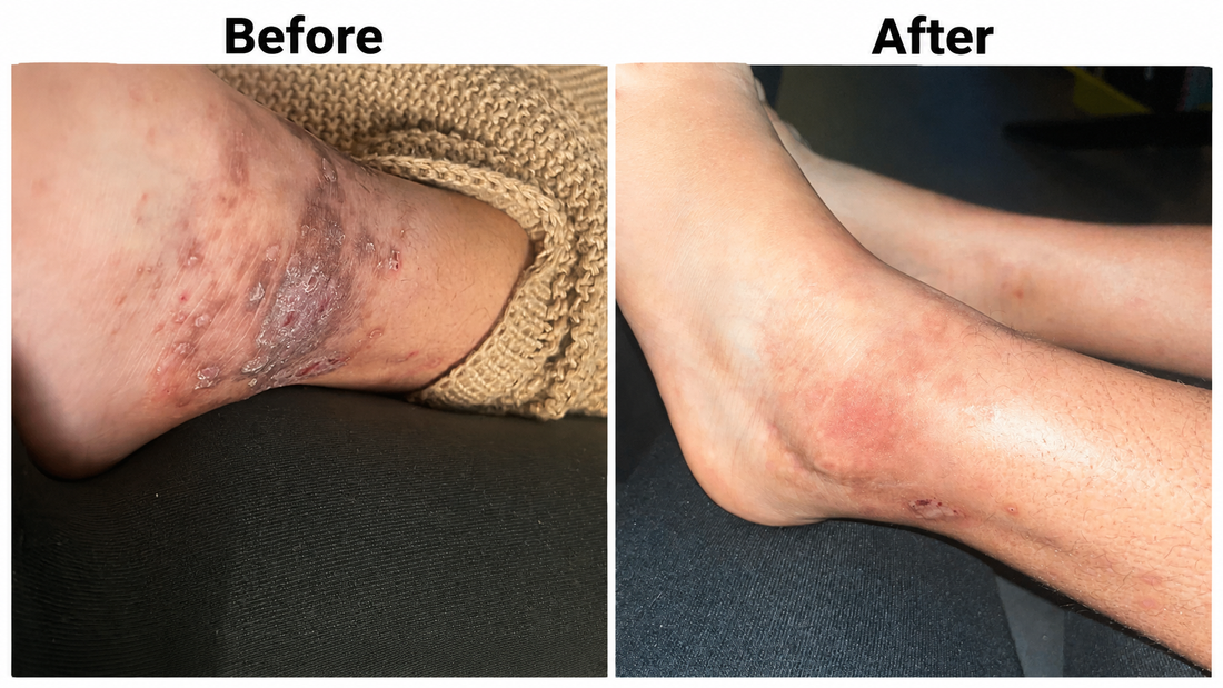 **Meta alt titel:** Before and after eczeem op enkel zichtbaar verbeterd na gebruik van natuurlijke psoriasis en eczeem zalf van Hair and Nature