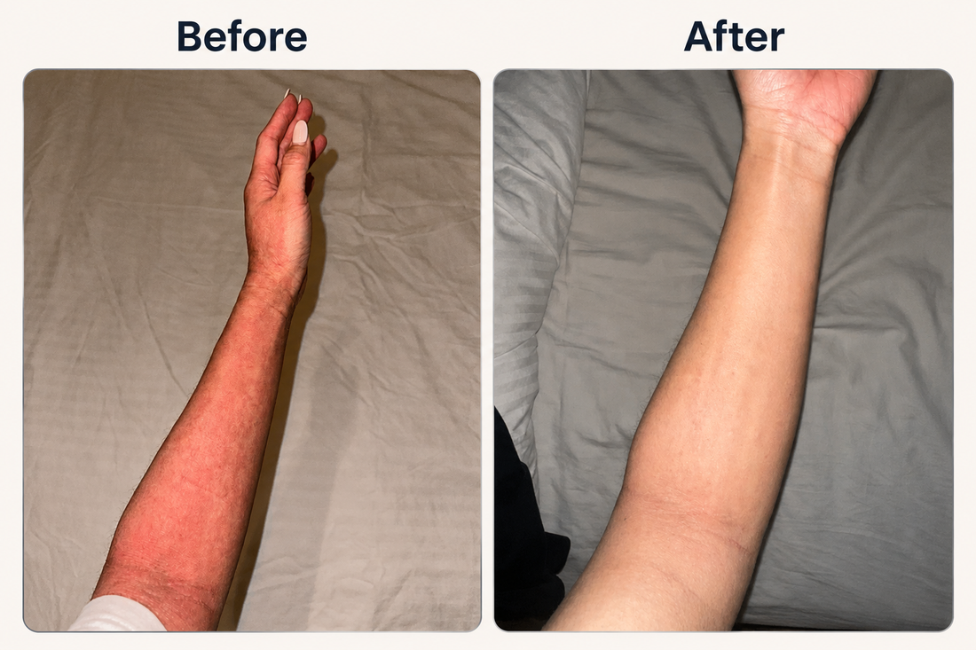 Eczeem op arm - before en after