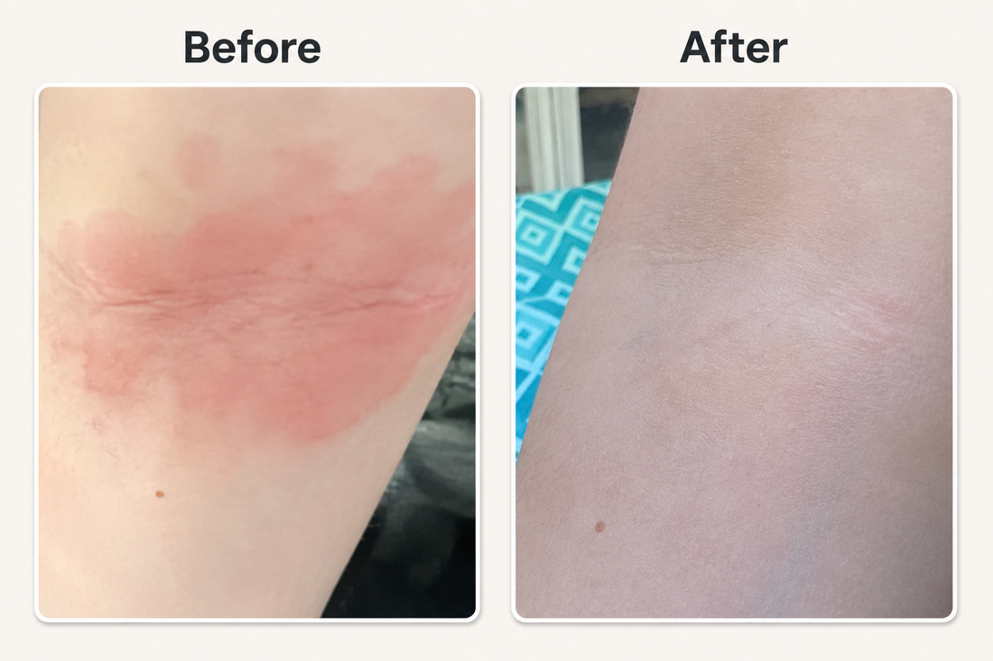 Before and after eczeem in huidplooi verminderen met natuurlijke psoriasis en eczeem zalf van Hair and Nature
