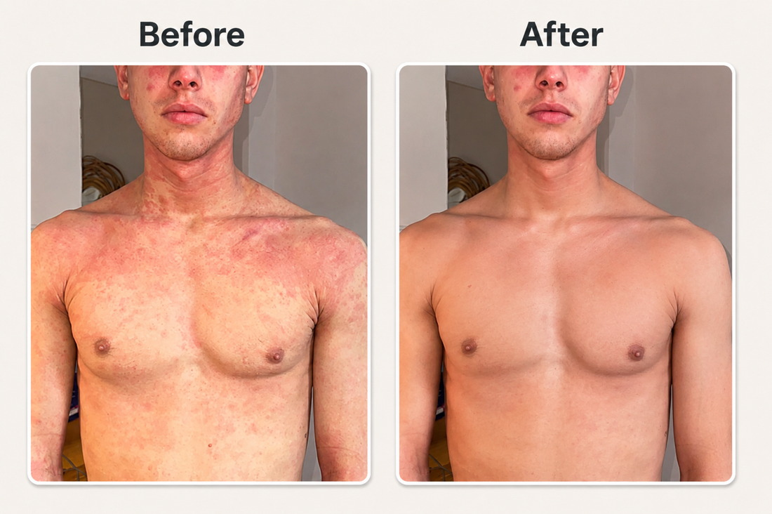 Before and after rode huid en eczeem op borst en hals verminderen met natuurlijke psoriasis en eczeem zalf van Hair and Nature