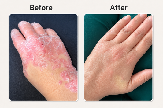 Before and after eczeem op hand verminderen met natuurlijke psoriasis en eczeem zalf van Hair and Nature