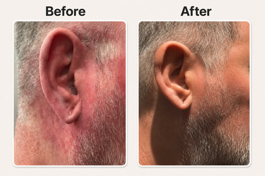 Before and after rode huid en eczeem op hals en gezicht verminderen met natuurlijke psoriasis en eczeem zalf van Hair and Nature