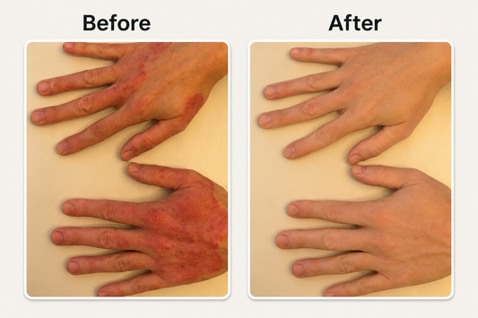 Before and after psoriasis op knie verminderen met natuurlijke psoriasis en eczeem zalf van Hair and Nature
