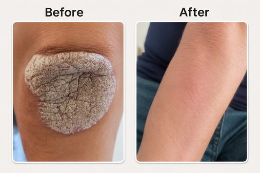 Before and after eczeem op handen verminderen met natuurlijke psoriasis en eczeem zalf van Hair and Nature