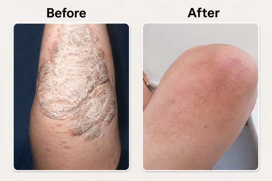 Before and after psoriasis op elleboog verminderen met natuurlijke psoriasis en eczeem zalf van Hair and Nature