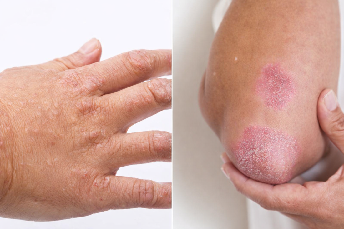  psoriasis en eczeem - hair and nature