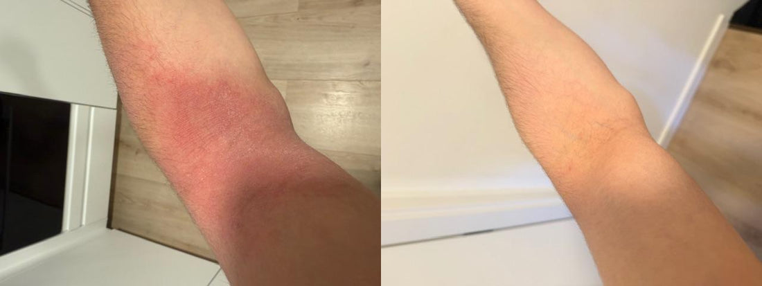 Psoriasis op arm voor en na behandeling met vermindering van roodheid en huidirritatie