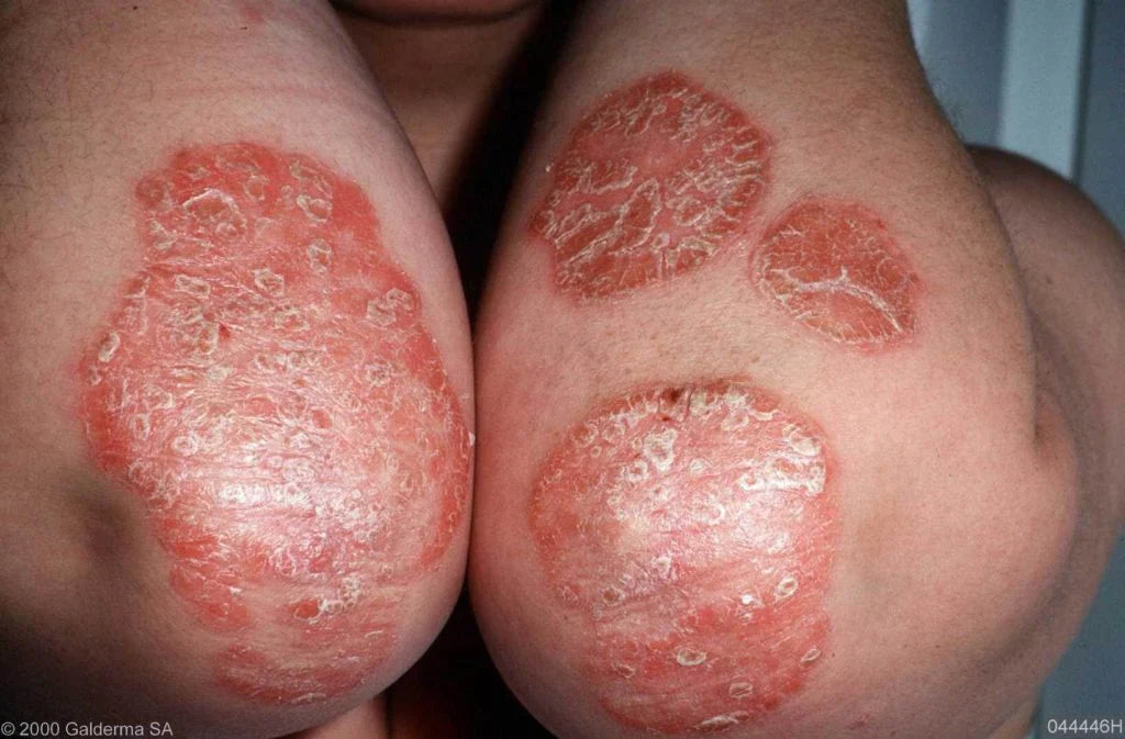 Psoriasis ellebogen behandelen – rode schilferige plekken op ellebogen verminderen met juiste huidverzorging