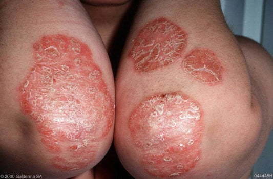 Psoriasis ellebogen behandelen – rode schilferige plekken op ellebogen verminderen met juiste huidverzorging