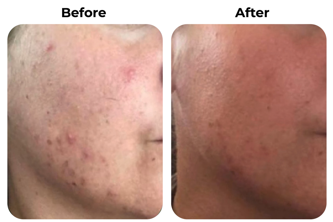 Before and after onrustige huid met rode plekjes zichtbaar rustiger en egaler geworden bij klant Liselotte