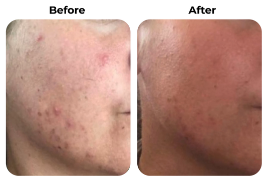 Before and after onrustige huid met rode plekjes zichtbaar rustiger en egaler geworden bij klant Liselotte