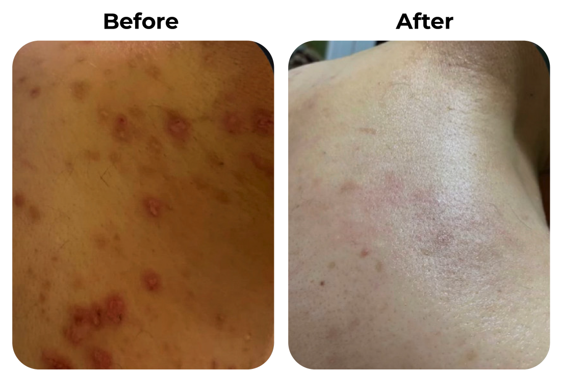 Before and after rode en geïrriteerde huid met ontstoken plekjes zichtbaar rustiger geworden bij klant Alex