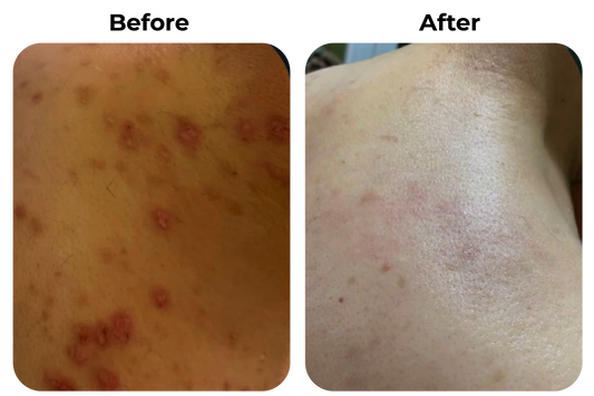 Before and after rode en geïrriteerde huid met ontstoken plekjes zichtbaar rustiger geworden bij klant Alex