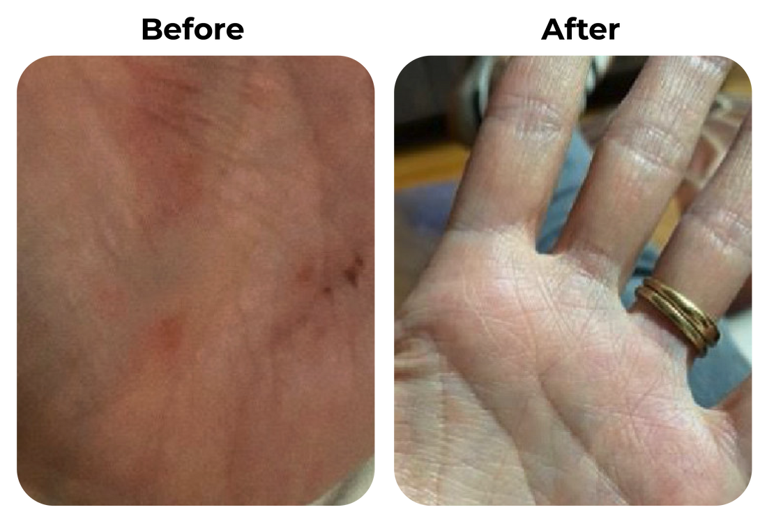 Before and after droge en geïrriteerde handen zichtbaar rustiger geworden na consequente huidverzorging bij klant Bas
