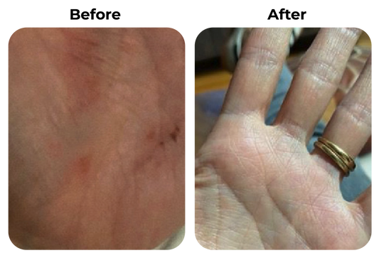 Before and after droge en geïrriteerde handen zichtbaar rustiger geworden na consequente huidverzorging bij klant Bas