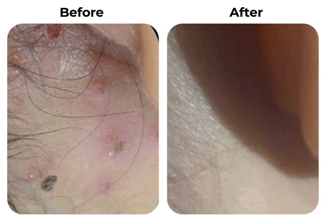 Before and after rode en geïrriteerde huid langs de haarlijn zichtbaar rustiger geworden bij klant Lisa
