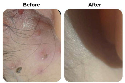 Before and after rode en geïrriteerde huid langs de haarlijn zichtbaar rustiger geworden bij klant Lisa