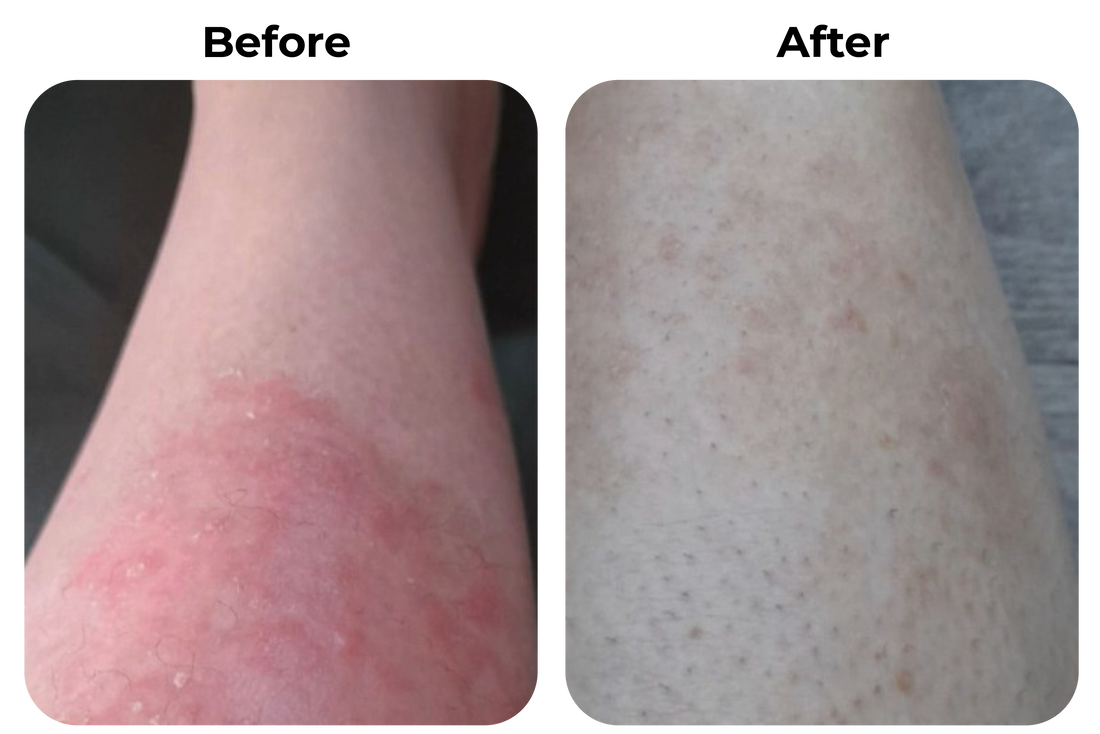 Before and after rode geïrriteerde huid op been zichtbaar verbeterd bij klant Anna