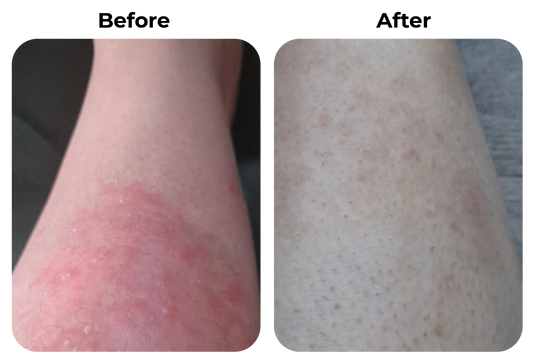 Before and after rode geïrriteerde huid op been zichtbaar verbeterd bij klant Anna