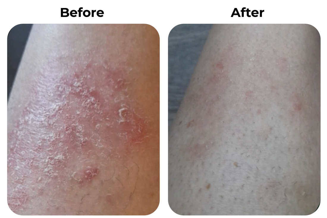 psoriasis been before after droge huid roodheid verminderd