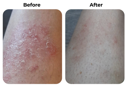 psoriasis been before after droge huid roodheid verminderd