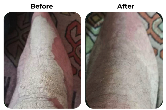 Before and after psoriasis en droge schilferige huid op been zichtbaar verbeterd bij klant Harry