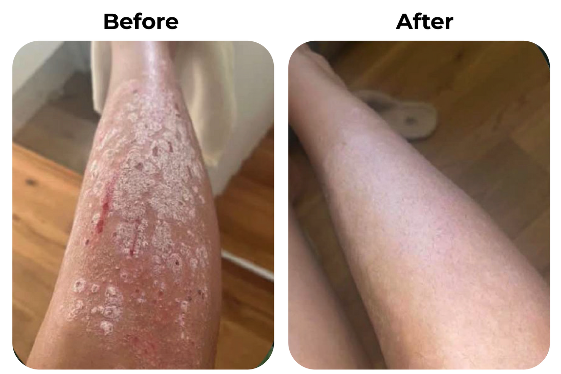 Before and after psoriasis of eczeem op been zichtbaar rustiger geworden bij klant Anneke