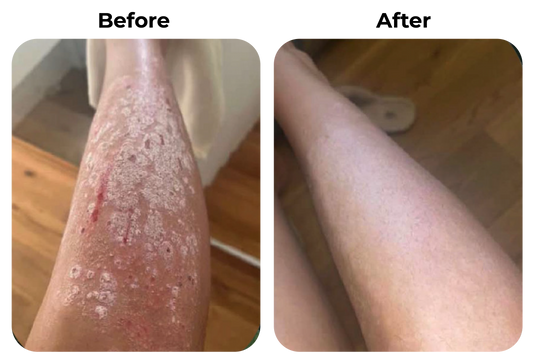 Before and after psoriasis of eczeem op been zichtbaar rustiger geworden bij klant Anneke