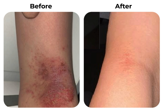 Before and after rode en geïrriteerde huid in huidplooi zichtbaar rustiger geworden bij klant Bram