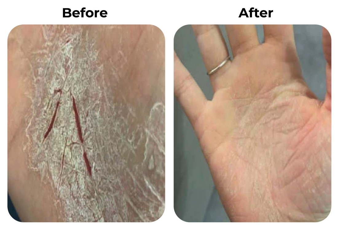 Before and after droge handen met kloven zichtbaar verbeterd bij klant Ozan