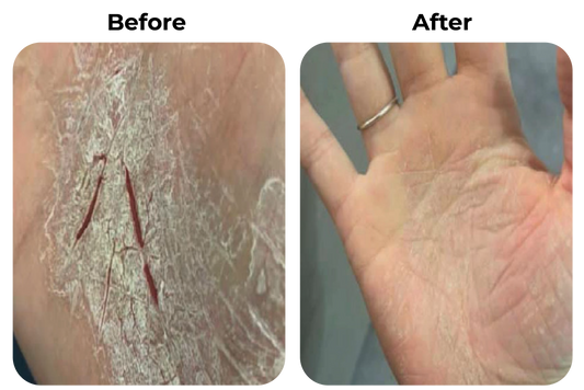 Before and after droge handen met kloven zichtbaar verbeterd bij klant Ozan