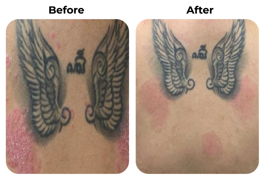 Before and after psoriasisplekken op nek en bovenrug zichtbaar verbeterd bij klant Monique