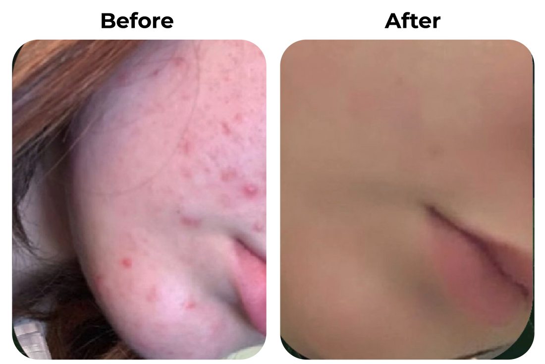 Before and after onrustige huid met puistjes zichtbaar verbeterd bij klant Lizzy