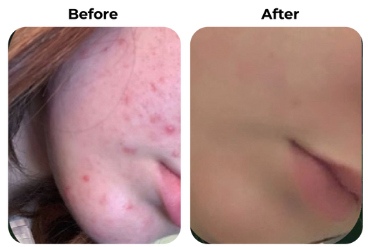 Before and after onrustige huid met puistjes zichtbaar verbeterd bij klant Lizzy