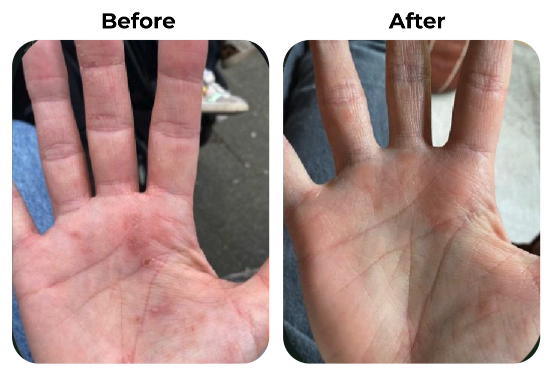 eczeem before en after binnen kant hand 