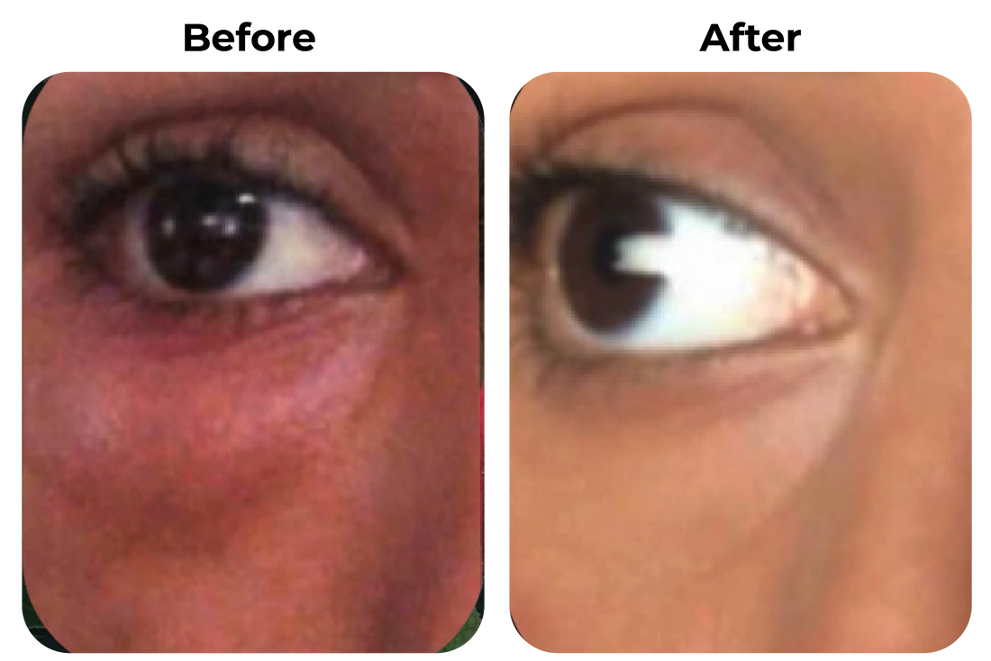 Before and after gevoelige rode huid onder oog zichtbaar rustiger geworden bij klant Seline