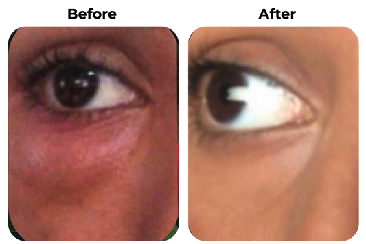 Before and after gevoelige rode huid onder oog zichtbaar rustiger geworden bij klant Seline