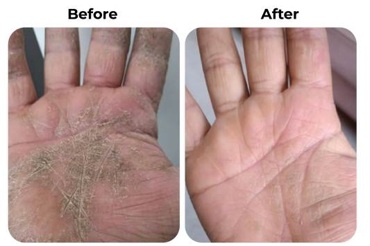 Before and after droge en schilferige handpalmen door eczeem behandeld met natuurlijke psoriasis en eczeem zalf van Hair and Nature