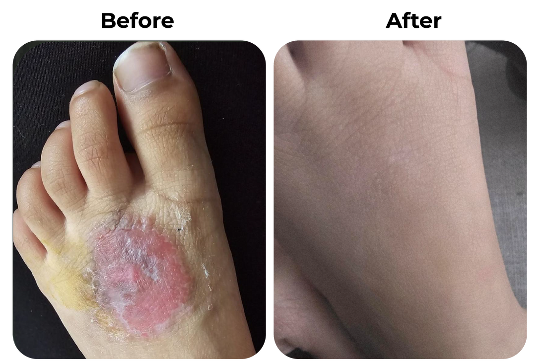 eczeem kind voet before after huid verbetering ontsteking hersteld