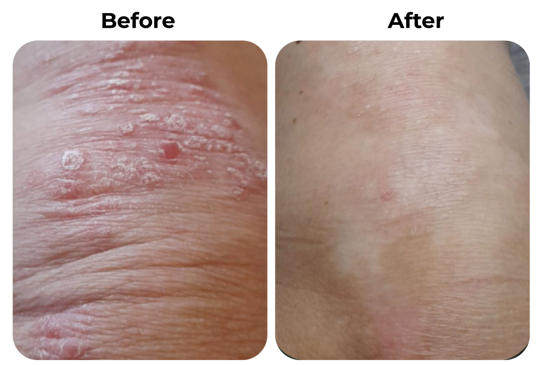 psoriasis knie before after huid verbetering roodheid schilfers verminderd