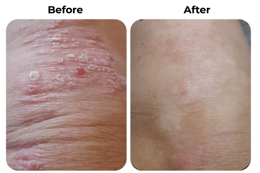 psoriasis knie before after huid verbetering roodheid schilfers verminderd