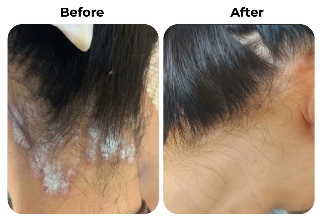 Before and after psoriasis in nek en haarlijn verminderen met natuurlijke psoriasis en eczeem zalf van Hair and Nature