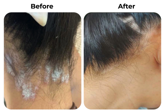 Before and after psoriasis in nek en haarlijn verminderen met natuurlijke psoriasis en eczeem zalf van Hair and Nature